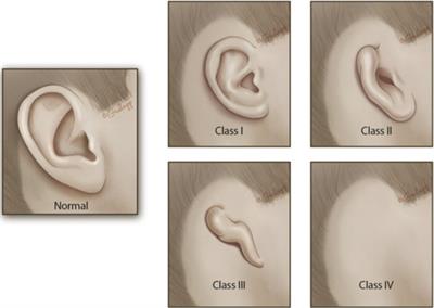 Integrated microtia and aural atresia management